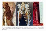 Use of bioengineered human acellular vessels to treat traumatic injuries in the Ukraine–Russia conflict