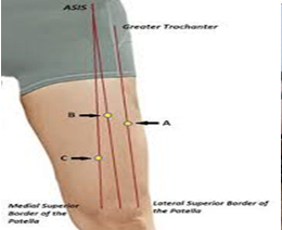 Effect of dry needling on quadriceps muscles fatigue in taekwondo players: A protocol for a triple-blinded randomized controlled trial