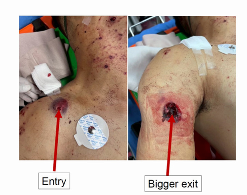 Critical care management in military warfare and blast-induced neurotrauma Lessons from the Thai Cambodian border conflict